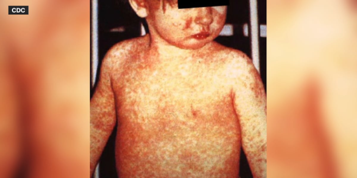 Measles Outbreak Alert: North Dakota Public Health Departments on High Alert